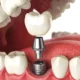 How Dental Implant Quotes Are Built: A Practical Cost Guide for Maple Grove, Minnesota