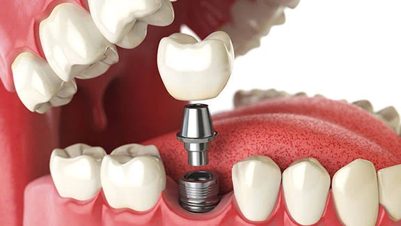 How Dental Implant Quotes Are Built: A Practical Cost Guide for Maple Grove, Minnesota